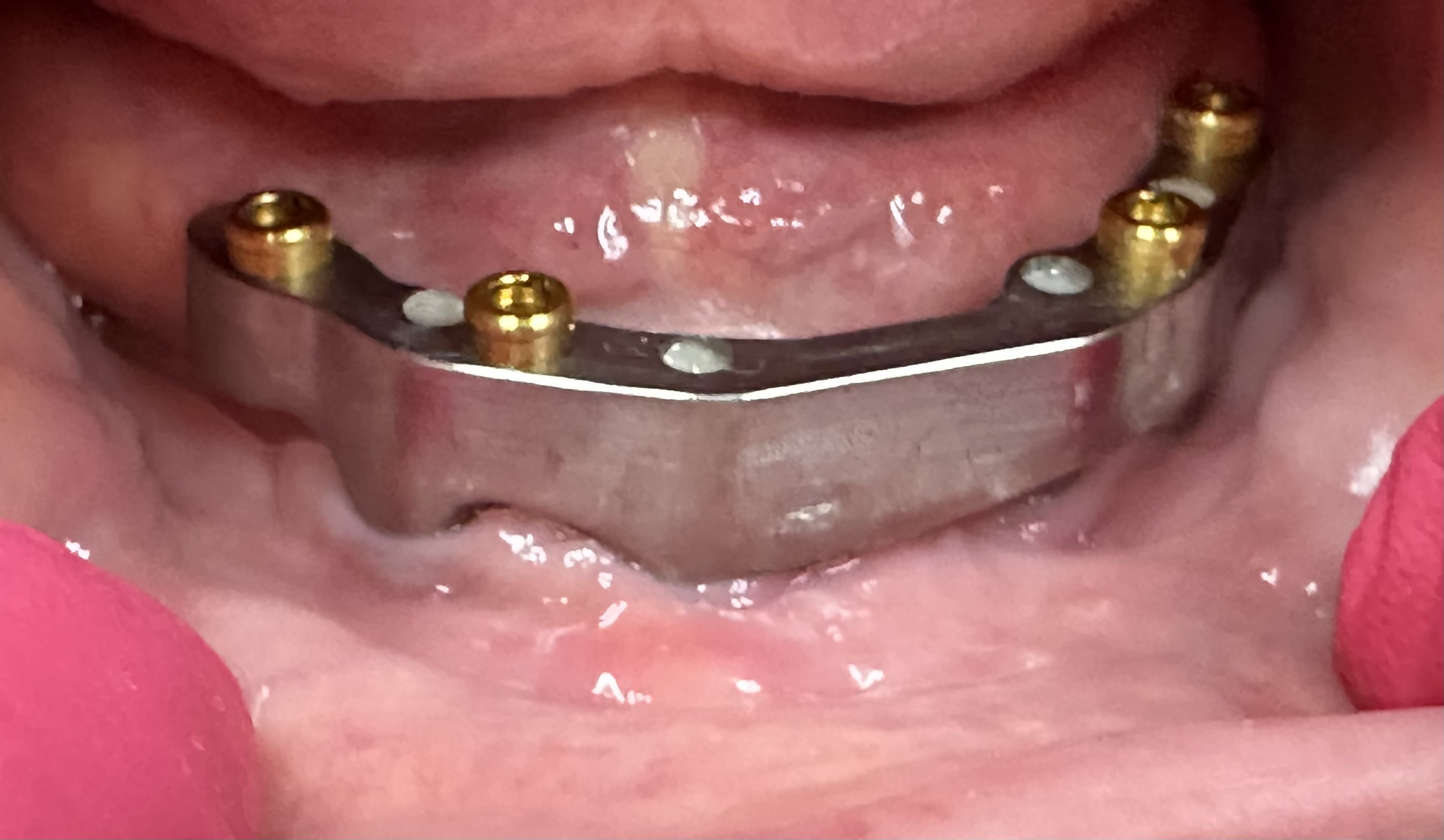Implant bar seated in patient